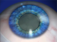 Eye Cataract 